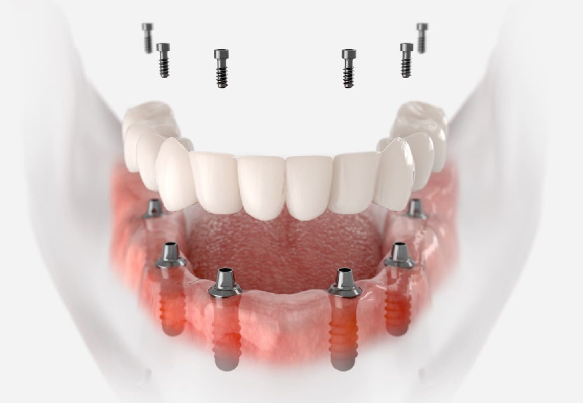 6+6天使之橋，整排缺牙或無牙者的新選擇！ - 雅德思牙醫診所